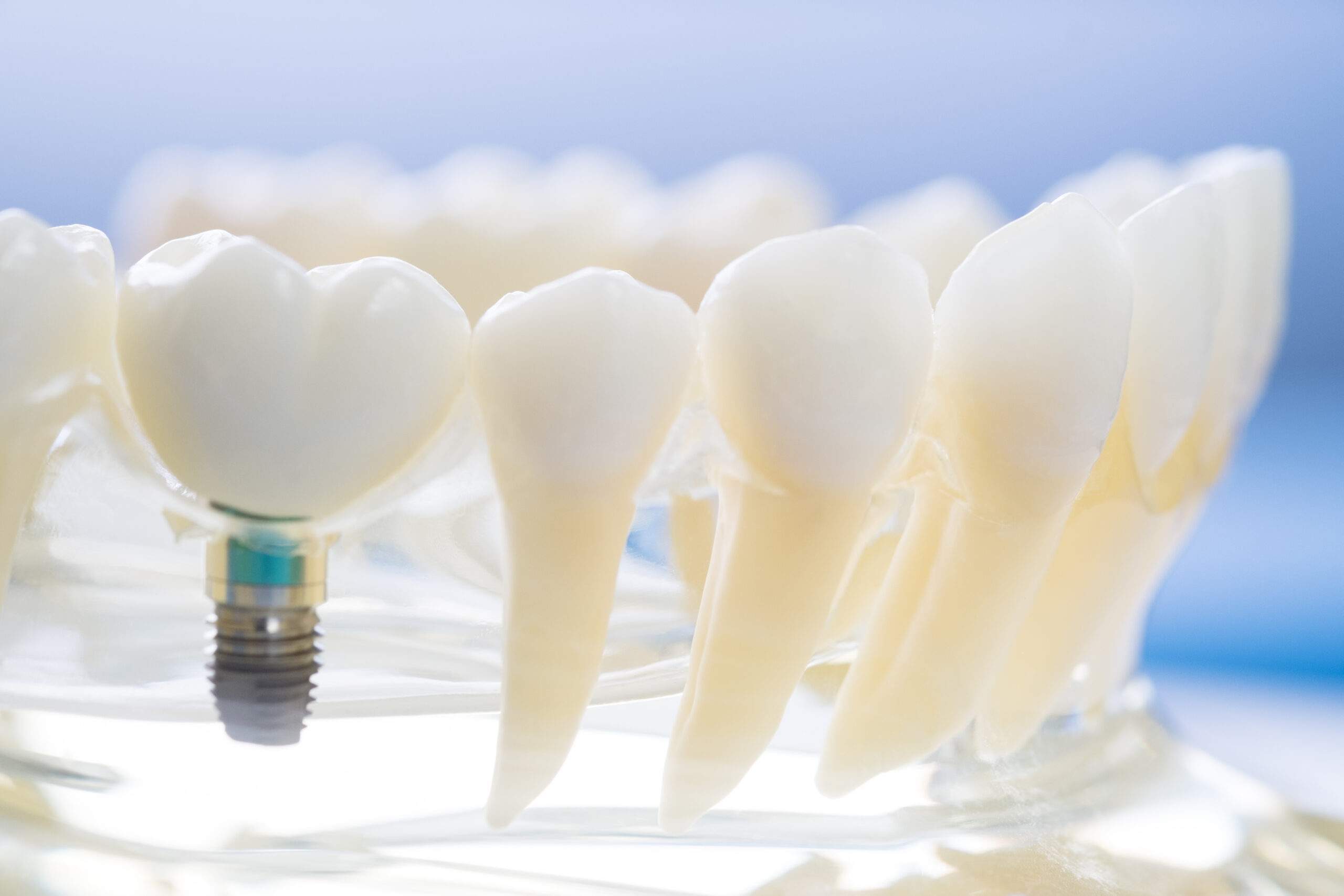 Implantes dentales de calidad en Coslada - San Fernando de Henares